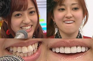 菊地亜美の出っ歯と整形後の歯