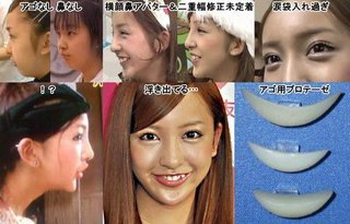 板野友美の顎用プロテーゼ